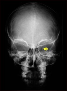 Neurofibromatosis I, agrandamiento de la abertura óptica