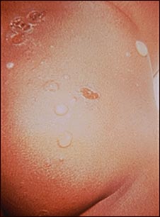 Impétigo, ampollas en las nalgas