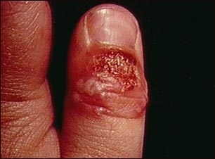 Panadizo herpético del pulgar