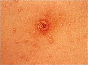 Molusco contagioso- primer plano del tórax