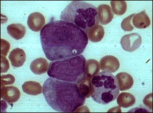 Leucemia mielocítica crónica