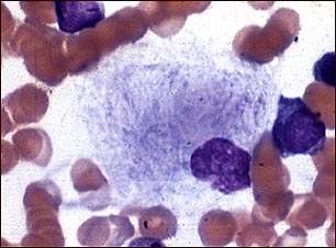 Microfotografía de célula de Gaucher