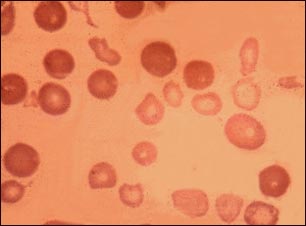 Talasemia mayor