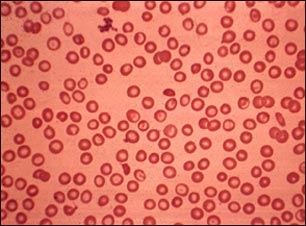 Talasemia menor