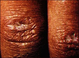 Pápula de Gottron en dermatomiositis