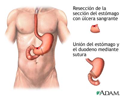 Procedimiento (tercera parte)