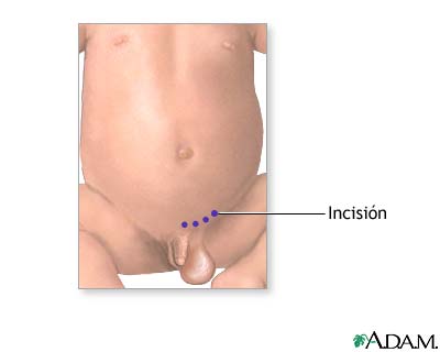 Incisi&oacute;n