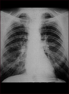 Pulmones de un trabajador del carbón; rayos X