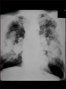 Neumoconiosis en trabajadores del carbón; complicada #2