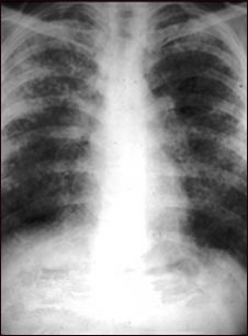 Sarcoidosis, estado II - radiografía de tórax