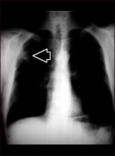 Masa pulmonar, pulmón superior derecho - Radiografía de tórax