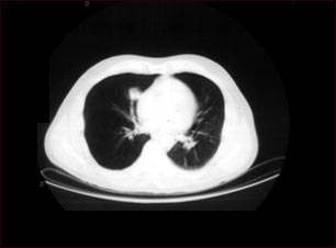 Nódulo pulmonar, pulmón inferior derecho - Tomografía computarizada
