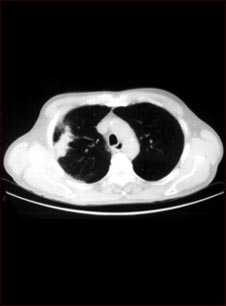 Pulmón con cáncer de células escamosas - Tomografía computarizada