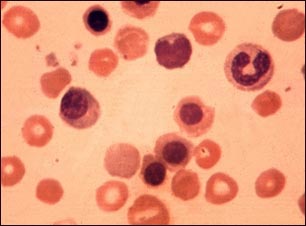 Eritroblastosis fetal- foto micrograf&iacute;a