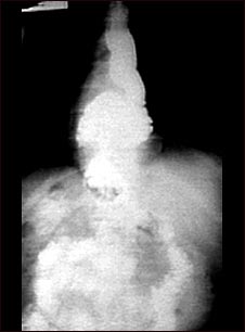 Radiograf&iacute;a de una hernia hiatal