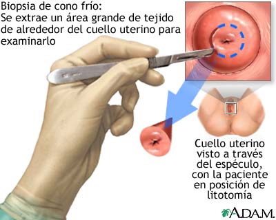 Biopsia de cono frío