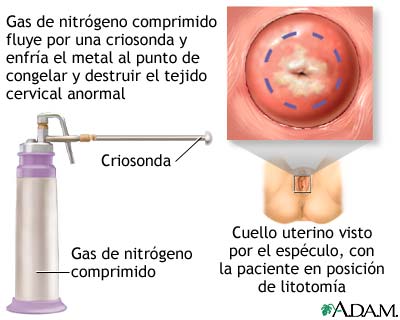 Criocirugía cervical