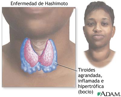 Enfermedad de Hashimoto (tiroiditis cr&oacute;nica)