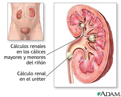 Nefrolitiasis
