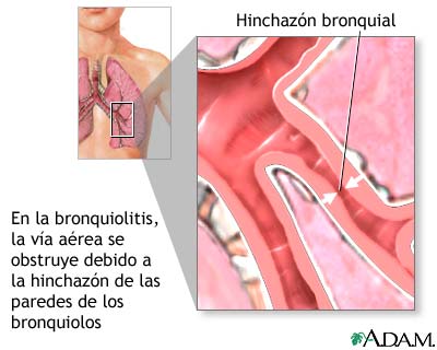Bronquiolitis
