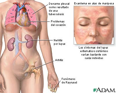 Lupus eritematoso sistémico