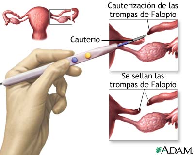 Ligadura tubárica