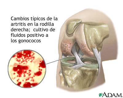 Artritis gonocócica
