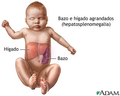 Hepatoesplenomegalia
