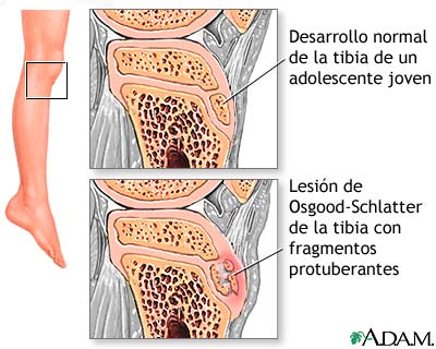 Dolor de pierna (lesión de Osgood-Schlatter)