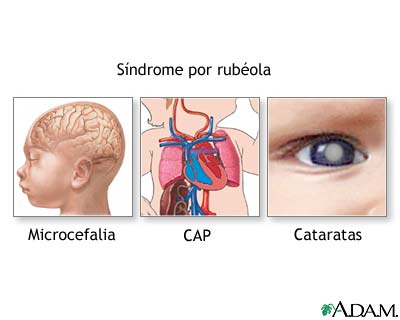 Síndrome de la rubéola