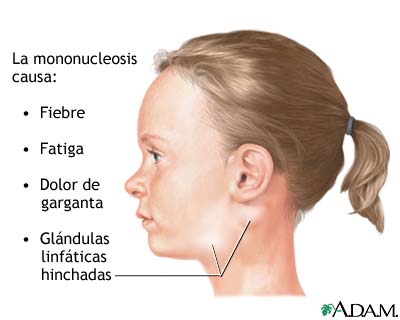 Mononucleosis infecciosa