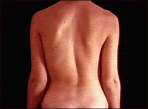Escoliosis