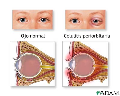 Celulitis periorbital
