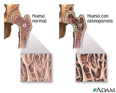Osteoporosis