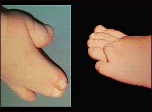 Sindactilia