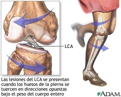 Lesión del LCA