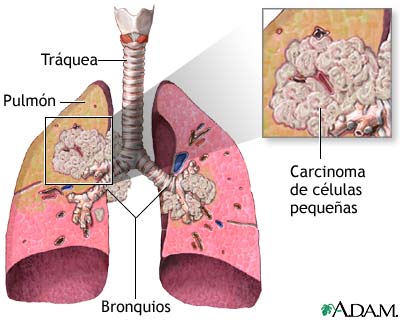 Carcinoma de c&eacute;lulas peque&ntilde;as