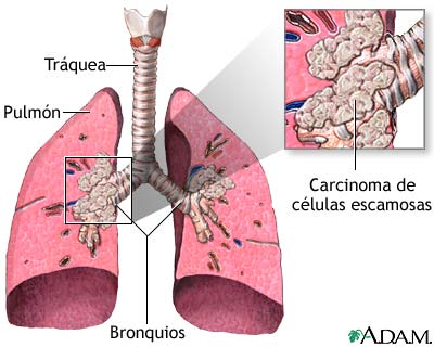 Carcinoma de c&eacute;lulas escamosas