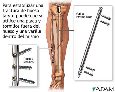 Dispositivos de fijación interna