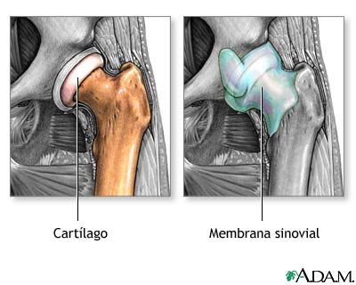 Osteoartritis contra artritis reumatoide
