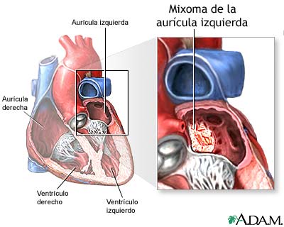 Mixoma de la aurícula izquierda