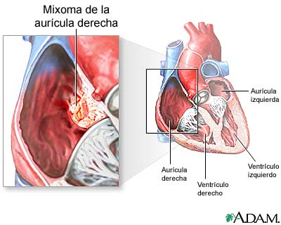 Mixoma de la aurícula derecha