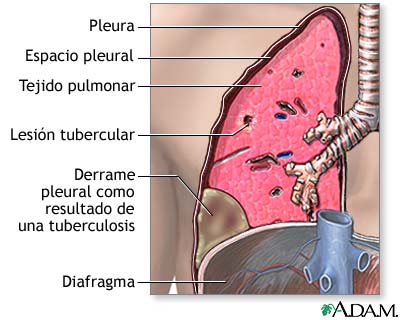 Efusión pleural