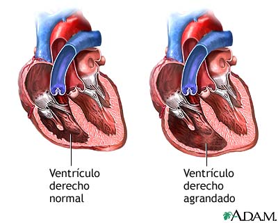 Regurgitación tricuspídea
