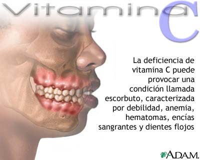 Déficit de vitamina C