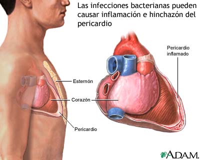 Pericarditis bacteriana
