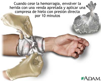 Detenci&oacute;n del sangrado con presi&oacute;n y hielo