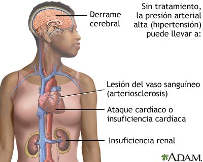 Hipertensión sin tratamiento