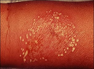 Pústulas superficiales en el brazo