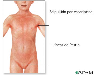Signos de escarlatina